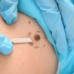 Why Visiting a Skin Cancer Clinic in Caloundra Is Important for Early Diagnosis