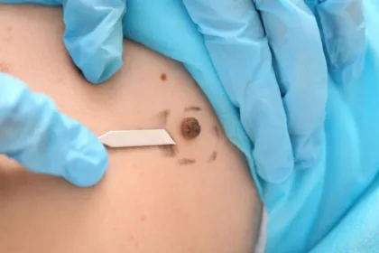 Why Visiting a Skin Cancer Clinic in Caloundra Is Important for Early Diagnosis